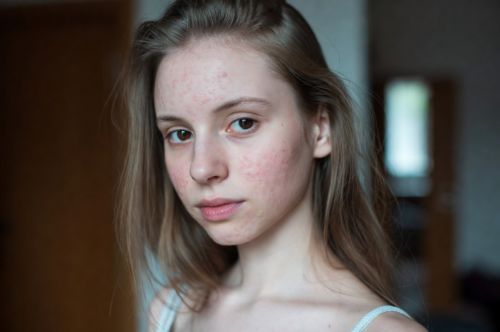 Акне (угревая сыпь)