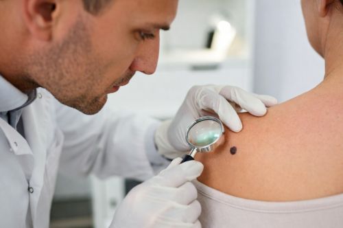Меланома: профилактика, скрининг, лечение